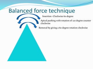 Balanced force technique
Insertion -Clockwise 60 degree
Apical pushing with rotation of 120 degree counter
clockwise
Removal by giving a 60 degree rotation clockwise
 