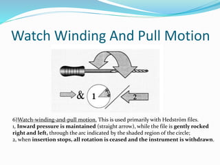 Watch Winding And Pull Motion
6)Watch-winding-and-pull motion. This is used primarily with Hedström files.
1, Inward pressure is maintained (straight arrow), while the file is gently rocked
right and left, through the arc indicated by the shaded region of the circle;
2, when insertion stops, all rotation is ceased and the instrument is withdrawn.
 