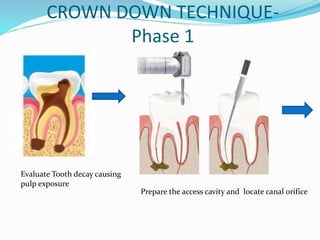 CROWN DOWN TECHNIQUE-
Phase 1
Evaluate Tooth decay causing
pulp exposure
Prepare the access cavity and locate canal orifice
 
