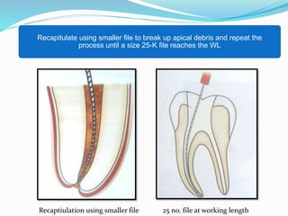 Remove intrumnt and irrigate the canal.
Recapitulate using smaller file to break up apical debris and repeat the
process until a size 25-K file reaches the WL
Recaptiulation using smaller file 25 no. file at working length
 