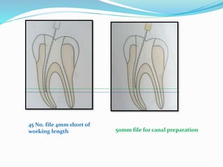 45 No. file 4mm short of
working length 50mm file for canal preparation
 