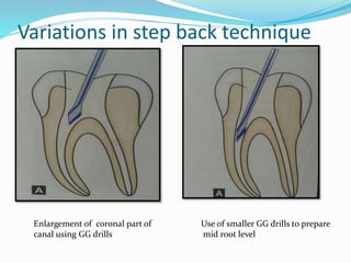 Variations in step back technique
Enlargement of coronal part of
canal using GG drills
Use of smaller GG drills to prepare
mid root level
 