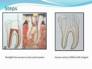 Steps
Straight line access to root canal system Access cavity is filled with irrigant
 