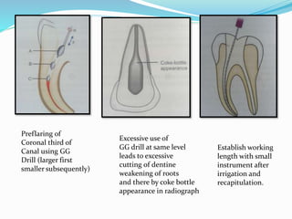 Preflaring of
Coronal third of
Canal using GG
Drill (larger first
smaller subsequently)
Excessive use of
GG drill at same level
leads to excessive
cutting of dentine
weakening of roots
and there by coke bottle
appearance in radiograph
Establish working
length with small
instrument after
irrigation and
recapitulation.
 