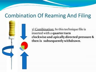 Combination Of Reaming And Filing
3) Combination: In this technique file is
inserted with a quarterturn
clockwiseand apicallydirected pressure &
then is subsequentlywithdrawn.
 