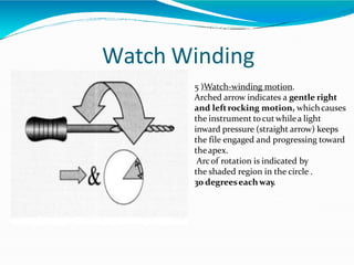 Watch Winding
5 )Watch-winding motion.
Arched arrow indicates a gentle right
and leftrocking motion, whichcauses
the instrument to cut whilea light
inward pressure (straight arrow) keeps
the file engaged and progressing toward
theapex.
Arcof rotation is indicated by
the shaded region in the circle .
30 degreeseachway.
 
