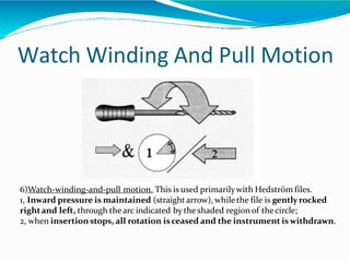 Watch Winding And Pull Motion
6)Watch-winding-and-pull motion. This is used primarilywith Hedström files.
1, Inward pressure is maintained (straight arrow), whilethe file is gentlyrocked
rightand left, through thearc indicated by theshaded regionof thecircle;
2, when insertionstops, all rotation is ceased and the instrument iswithdrawn.
 
