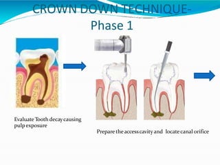 CROWN DOWN TECHNIQUE-
Phase 1
Evaluate Tooth decaycausing
pulp exposure
Prepare theaccesscavity and locatecanal orifice
 