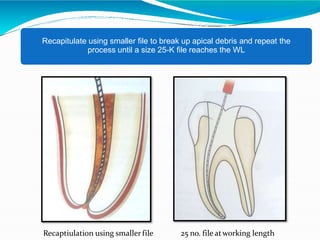 Remove intrumnt and irrigate the canal.
Recapitulate using smaller file to break up apical debris and repeat the
process until a size 25-K file reaches the WL
Recaptiulation using smaller file 25 no. file atworking length
 