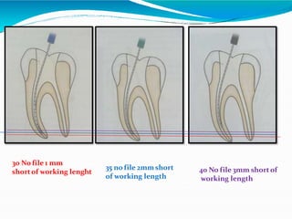 30 No file 1 mm
shortof working lenght
35 no file 2mm short
of working length
40 No file 3mm shortof
working length
 