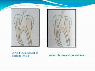 45 No. file 4mmshortof
working length 50mm file forcanal preparation
 