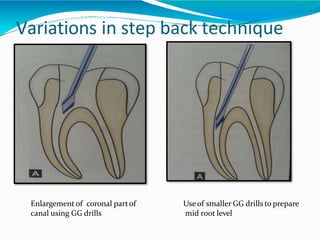 Variations in step back technique
Enlargement of coronal partof
canal using GG drills
Useof smaller GG drills to prepare
mid root level
 