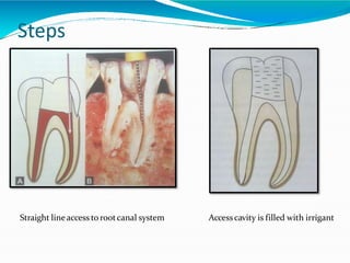 Steps
Straight lineaccess to rootcanal system Accesscavity is filled with irrigant
 