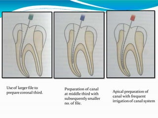 Useof larger file to
preparecoronal third.
Preparation of canal
at middle third with
subsequently smaller
no. of file.
Apical preparation of
canal with frequent
irrigation of canal system
 