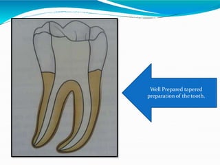 Well Prepared tapered
preparation of the tooth.
 