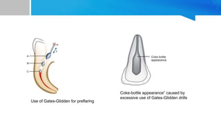 Use of Gates-Glidden for preflaring
Coke-bottle appearance” caused by
excessive use of Gates-Glidden drills
 