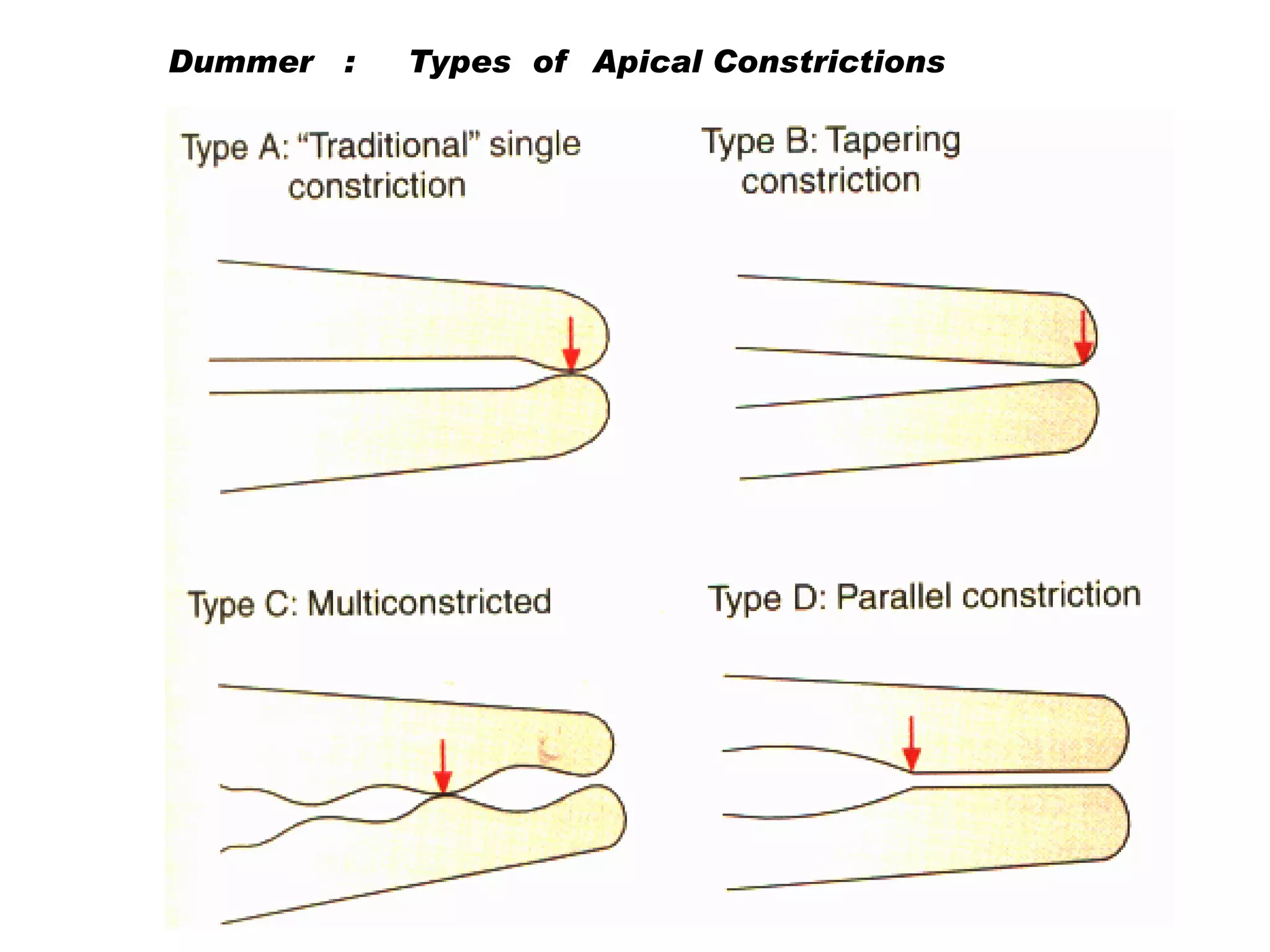 Dummer :

Types of Apical Constrictions

 