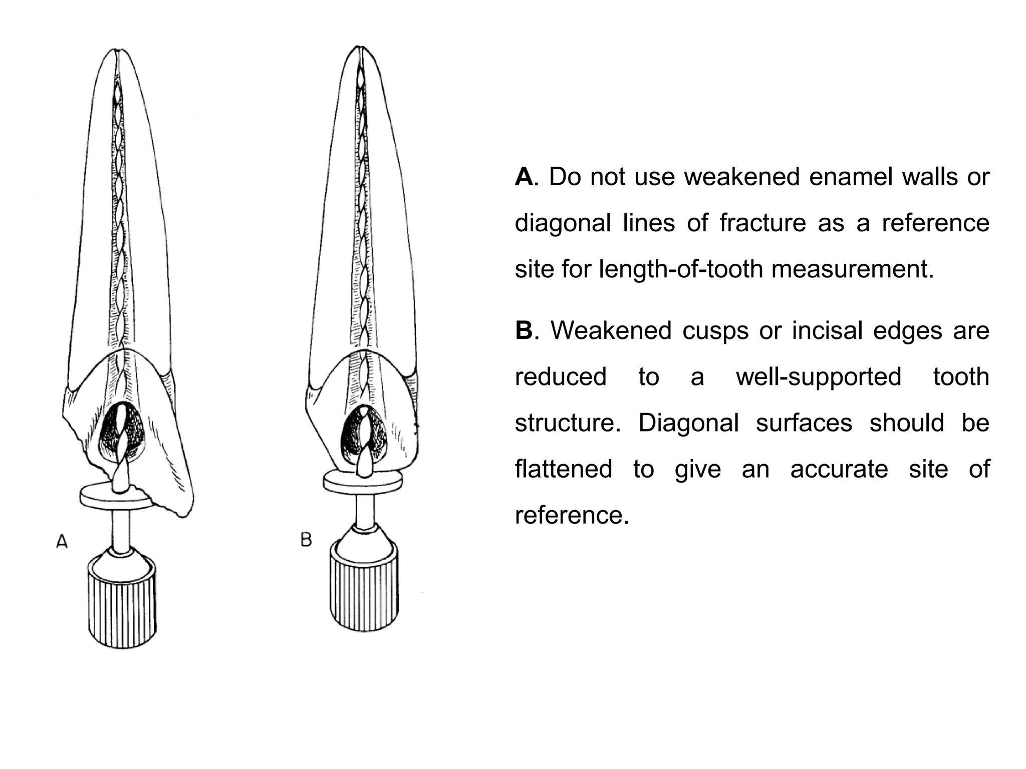 A. Do not use weakened enamel walls or
diagonal lines of fracture as a reference

site for length-of-tooth measurement.
B. Weakened cusps or incisal edges are
reduced

to

a

well-supported

tooth

structure. Diagonal surfaces should be
flattened to give an accurate site of
reference.

 