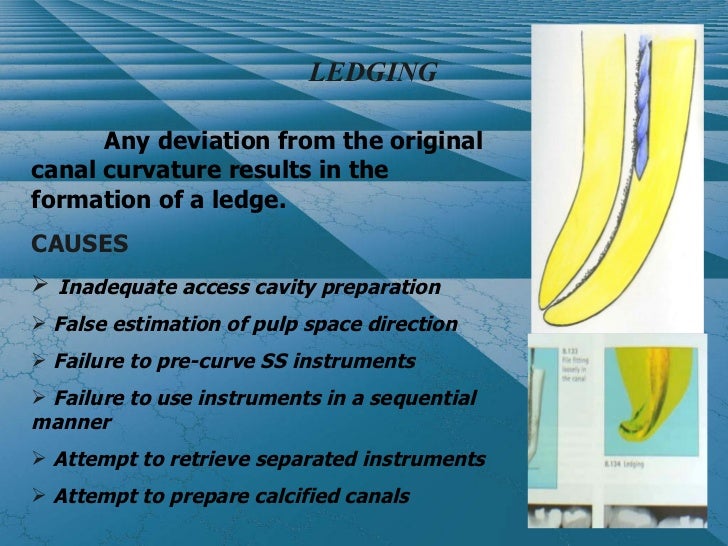 Cleaning and shaping the root canal system