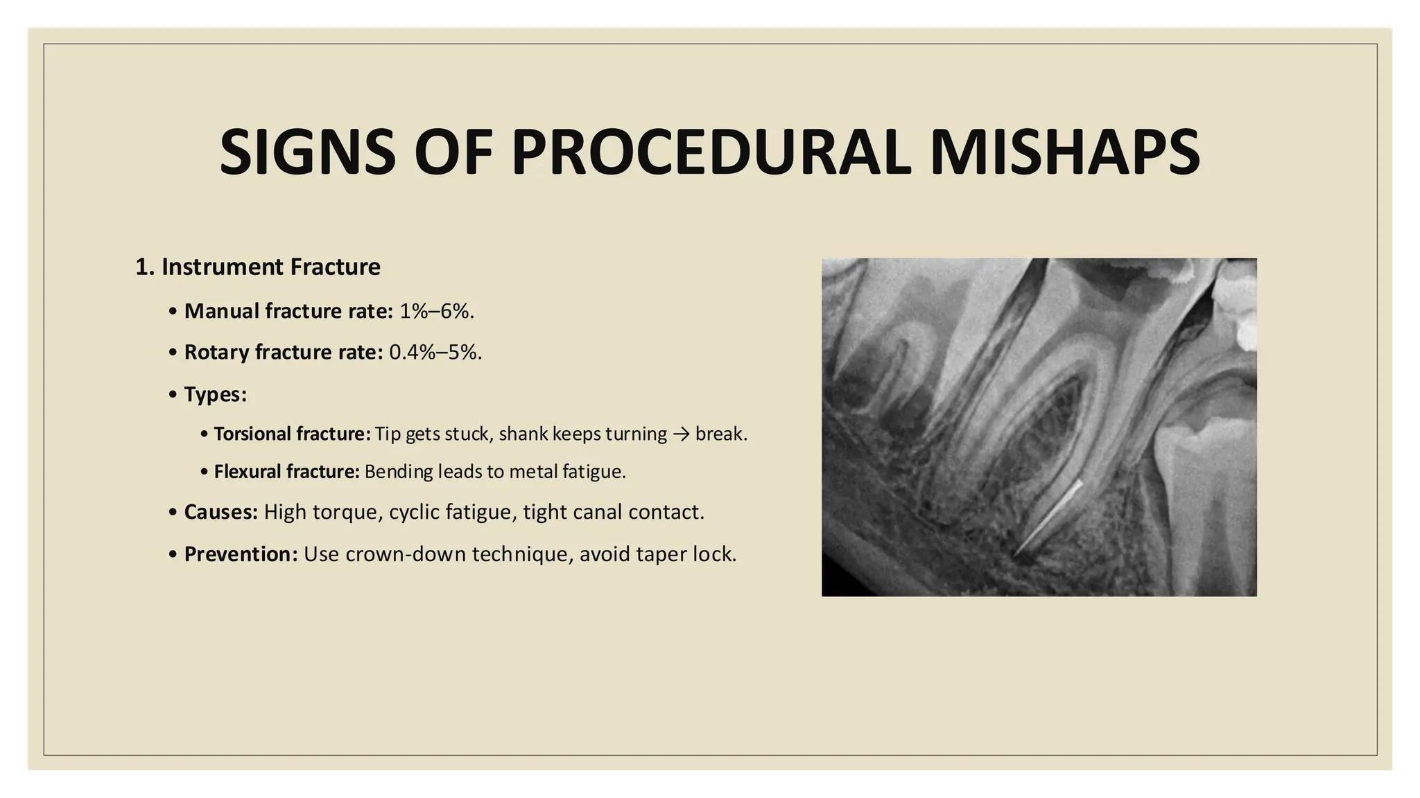 SIGNS OF PROCEDURAL MISHAPS
1. Instrument Fracture
• Manual fracture rate: 1%–6%.
• Rotary fracture rate: 0.4%–5%.
• Types:
• Torsional fracture: Tip gets stuck, shank keeps turning → break.
• Flexural fracture: Bending leads to metal fatigue.
• Causes: High torque, cyclic fatigue, tight canal contact.
• Prevention: Use crown-down technique, avoid taper lock.
 