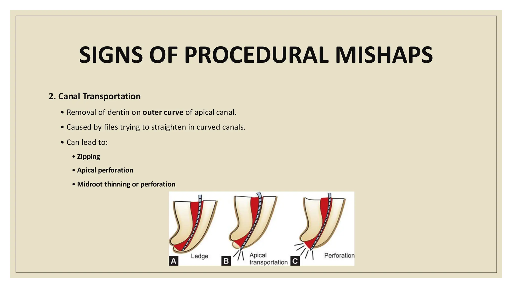 SIGNS OF PROCEDURAL MISHAPS
2. Canal Transportation
• Removal of dentin on outer curve of apical canal.
• Caused by files trying to straighten in curved canals.
• Can lead to:
• Zipping
• Apical perforation
• Midroot thinning or perforation
 