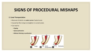 SIGNS OF PROCEDURAL MISHAPS
2. Canal Transportation
• Removal of dentin on outer curve of apical canal.
• Caused by files trying to straighten in curved canals.
• Can lead to:
• Zipping
• Apical perforation
• Midroot thinning or perforation
 