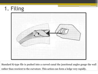 1. Filing
Standard K-type file is pushed into a curved canal the junctional angles gouge the wall
rather than reorient to the curvature. This action can form a ledge very rapidly.
 