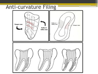Anti-curvature Filing
 