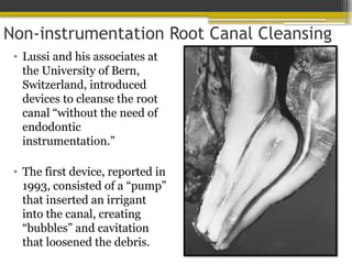 Non-instrumentation Root Canal Cleansing
• Lussi and his associates at
the University of Bern,
Switzerland, introduced
devices to cleanse the root
canal “without the need of
endodontic
instrumentation.”
• The first device, reported in
1993, consisted of a “pump”
that inserted an irrigant
into the canal, creating
“bubbles” and cavitation
that loosened the debris.
 