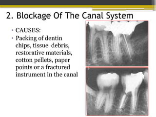 2. Blockage Of The Canal System
• CAUSES:
• Packing of dentin
chips, tissue debris,
restorative materials,
cotton pellets, paper
points or a fractured
instrument in the canal
 