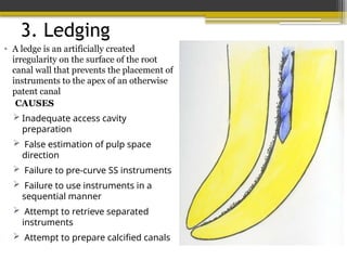 3. Ledging
• A ledge is an artificially created
irregularity on the surface of the root
canal wall that prevents the placement of
instruments to the apex of an otherwise
patent canal
CAUSES
 Inadequate access cavity
preparation
 False estimation of pulp space
direction
 Failure to pre-curve SS instruments
 Failure to use instruments in a
sequential manner
 Attempt to retrieve separated
instruments
 Attempt to prepare calcified canals
 