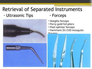 Retrieval of Separated Instruments
• Ultrasonic Tips
• Stieglitz forceps
• Perry gold foil pliers
• Peet splinter forceps
• Hartment 3½ CVD mosquito
forceps
• Forceps
 