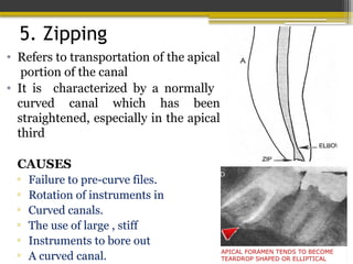 5. Zipping
• Refers to transportation of the apical
portion of the canal
• It is characterized by a normally
curved canal which has been
straightened, especially in the apical
third
CAUSES
▫ Failure to pre-curve files.
▫ Rotation of instruments in
▫ Curved canals.
▫ The use of large , stiff
▫ Instruments to bore out
▫ A curved canal.
APICAL FORAMEN TENDS TO BECOME
TEARDROP SHAPED OR ELLIPTICAL
 