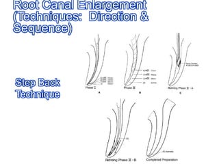Root Canal Enlargement(Techniques:  Direction & Sequence)Step Back Technique