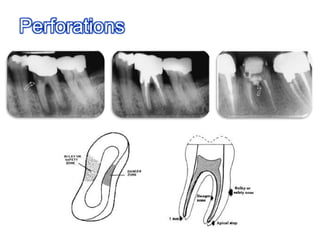 Use hybrid techniques (Enlarge coronally first)