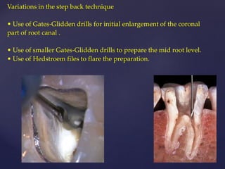 Variations in the step back technique
• Use of Gates-Glidden drills for initial enlargement of the coronal
part of root canal .
• Use of smaller Gates-Glidden drills to prepare the mid root level.
• Use of Hedstroem files to flare the preparation.
 