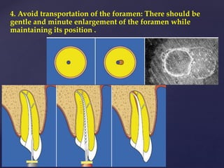 4. Avoid transportation of the foramen: There should be
gentle and minute enlargement of the foramen while
maintaining its position .
 