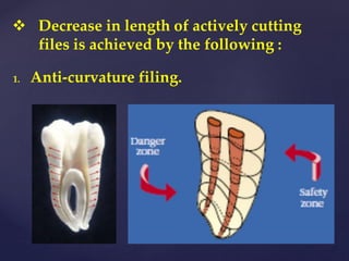 1. Anti-curvature filing.
 Decrease in length of actively cutting
files is achieved by the following :
 
