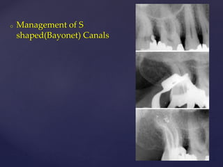 o Management of S
shaped(Bayonet) Canals
 