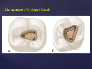 o Management of C-shaped Canals
 