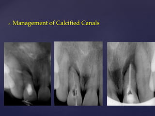 o Management of Calcified Canals
 