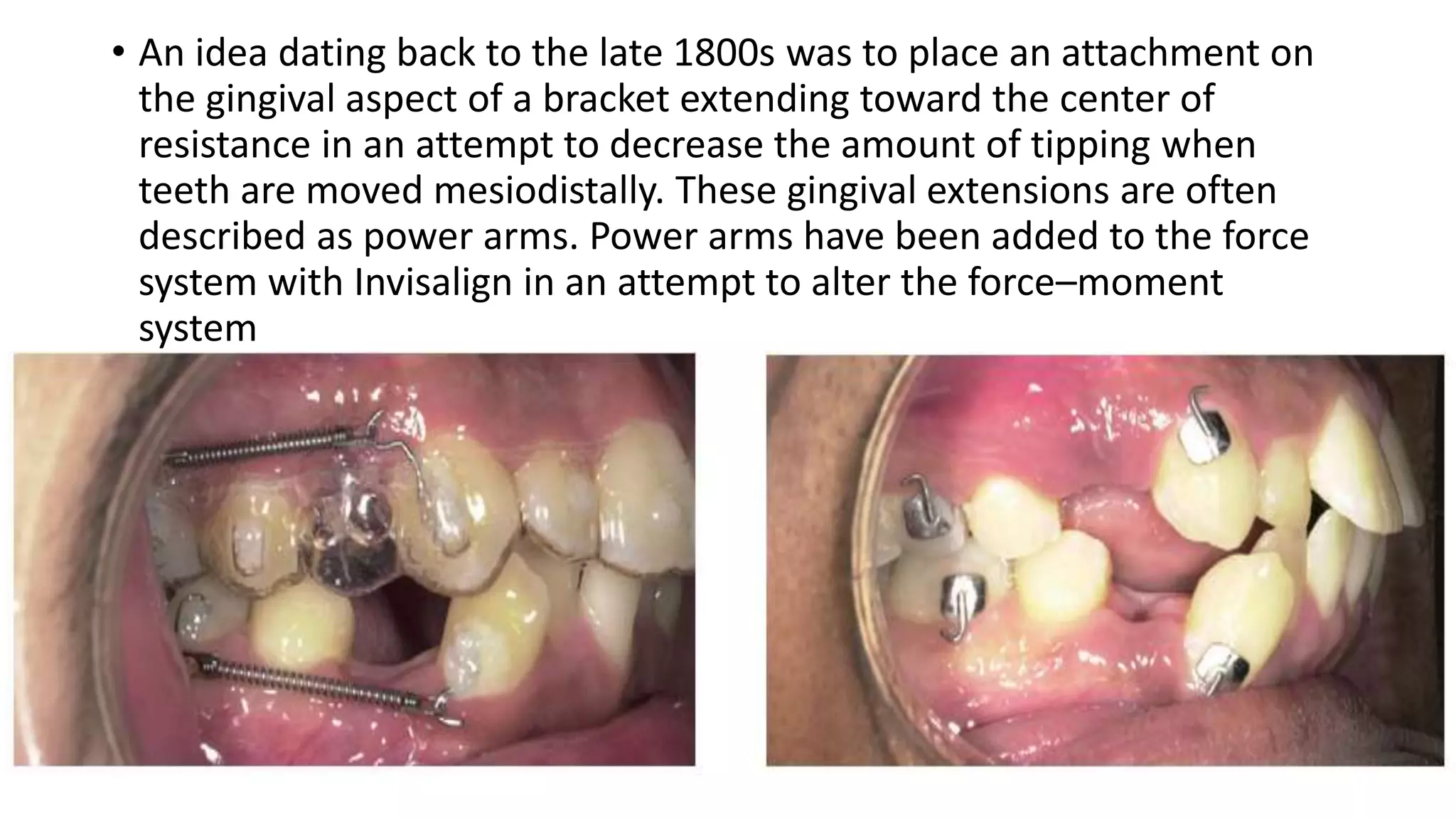 Power Chain Invisalign Clear aligner part ii | PPTX