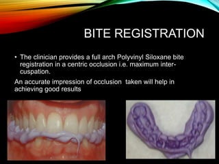 BITE REGISTRATION
• The clinician provides a full arch Polyvinyl Siloxane bite
registration in a centric occlusion i.e. maximum inter-
cuspation.
An accurate impression of occlusion taken will help in
achieving good results
 