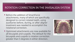 CLEAR ALIGNERS Basic And Types Of Attachment | PPTX