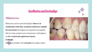 AuxiliariesandInvisalign
Miniscrews can be used with aligners alone or in
combination with other auxiliaries (button) to simplify
the movements the aligners are required to accomplish.
The two most common uses of miniscrews with aligners
are for vertical and sagittal movements.
Examples:
•One such example is the extrusion of an upper canine.
•Miniscrews:
 