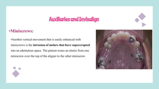 AuxiliariesandInvisalign
•Miniscrews:
•Another vertical movement that is easily enhanced with
miniscrews is the intrusion of molars that have supererupted
into an edentulous space. The patient wears an elastic from one
miniscrew over the top of the aligner to the other miniscrew.
 