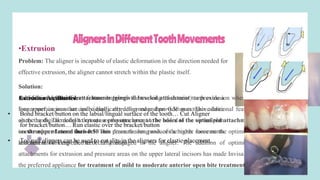 AlignersinDifferentToothMovements
•Extrusion
Problem: The aligner is incapable of elastic deformation in the direction needed for
effective extrusion, the aligner cannot stretch within the plastic itself.
Solution:
•addition of optimized attachments (gingival beveled attachment) to provide a
longer surface area that can be elastically deformed and provide an extrusive force
on the tooth. The default that causes the attachment to be added to the virtual plan
is extrusion of more than 0.50 mm down the long axis of the tooth. movements
less than this are expected to occur unaided
An additional SmartForce feature improves the tracking of anterior teeth extrusion when all
four upper incisors are individually extruding more than 0.50 mm. This additional feature
alters the digital model to create a pressure area at the bases of the optimized attachment
on the upper lateral incisors. This pressure area produces a higher force on the optimized
attachment to keep the teeth fully engaged in the aligner. The addition of optimized
attachments for extrusion and pressure areas on the upper lateral incisors has made Invisalign
the preferred appliance for treatment of mild to moderate anterior open bite treatment.
Extrusion Auxiliaries:
• Bond bracket/button on the labial/lingual surface of the tooth… Cut Aligner
for bracket/button… Run elastic over the bracket/button
• Toe nail clippers can be used to cut slits in the aligners for elastic placement.
 