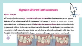 AlignersinDifferentToothMovements
•Root Torque
•Align technology introduced power ridges and pressure point in order to produce couple
that can produce root movement in the bucco-lingual direction.
• A second method of producing torque is to constrain the crown position while tending to move the
crown in an opposite direction to the direction of root movement. An example if we constrain lower
incisors by a fixed archwire or clear aligner and try to move upper incisors lingually while there is an
adequate overbite, lingual movement of upper incisors would torque lower incisors roots labially
• A third possible way to torque roots with clear aligners is to move the crowns initially in the opposite
direction of the intended direction of root torque. For example, if we need to torque upper incisors’
roots palatally, we would move the crown labially first (counter moment first) and then moving the whole
tooth palatally. This is similar to the traditional way of dealing with class II division 2 cases, where it is
always recommended to procline upper incisors labially first (providing adequate torque) and then moving
the upper incisors afterwards palatally.
 