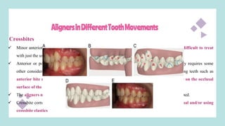 AlignersinDifferentToothMovements
Crossbites
 Minor anterior or posterior crossbites with a bite depth up to about10% are usually not difficult to treat
with just the usual aligner treatment.
 Anterior or posterior crossbites with a bite depth greater than approximately10% usually requires some
other considerations to open the vertical to allow the tooth in crossbite to clear the opposing teeth such as
anterior bite ramps that are available on the Invisalign aligners or placing cold-cure acrylic on the occlusal
surface of the aligners while the crossbite is being jumbed.
 The aligners may need to be worn full-time including while eating until the crossbite is jumped.
 Crossbite correction of posterior teeth may be facilitated by placing attachments on the lingual and/or using
crossbite elastics
 