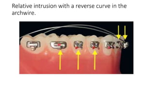 Relative intrusion with a reverse curve in the
archwire.
 
